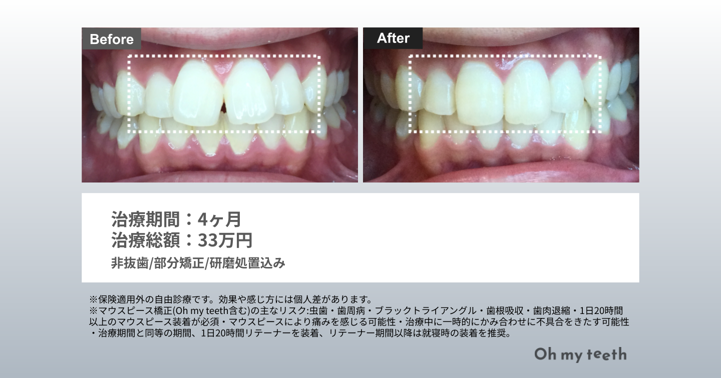 すきっ歯 矯正 前歯だけ 症例写真(スキッパ4ヶ月)