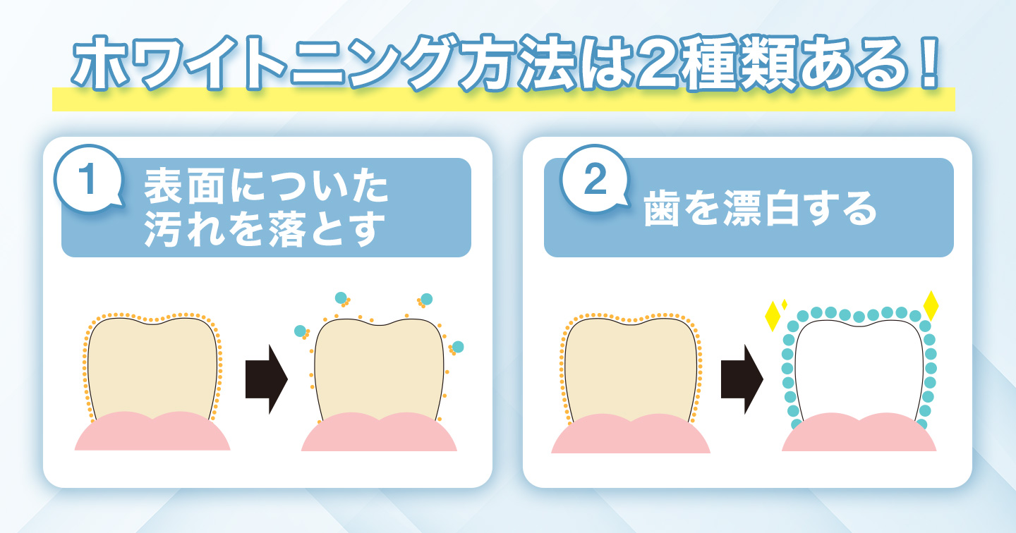 ホワイトニング方法は2種類ある!