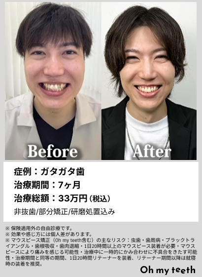 全顔BA・ガタガタ歯