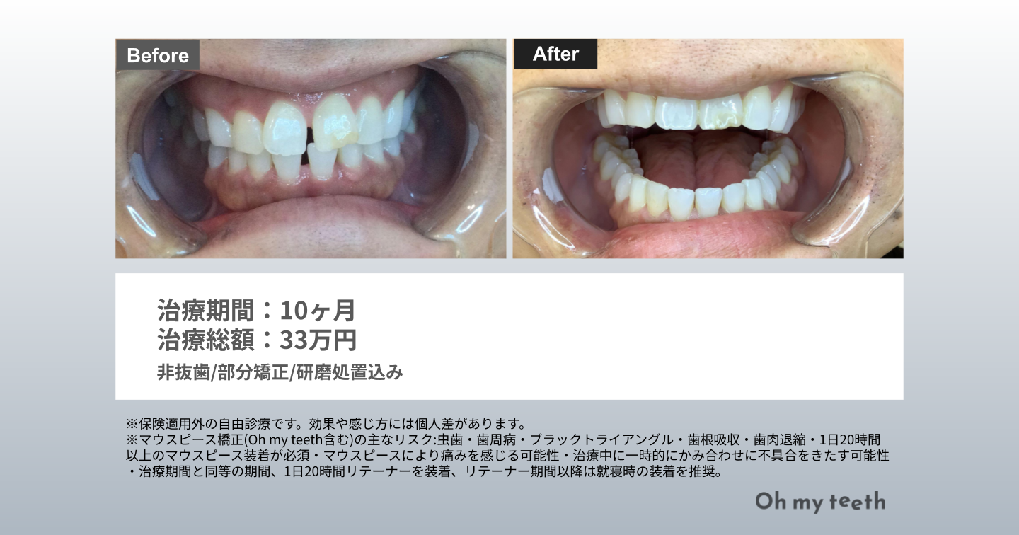 すきっ歯 矯正 前歯だけ 症例写真(すきっ歯10ヶ月)