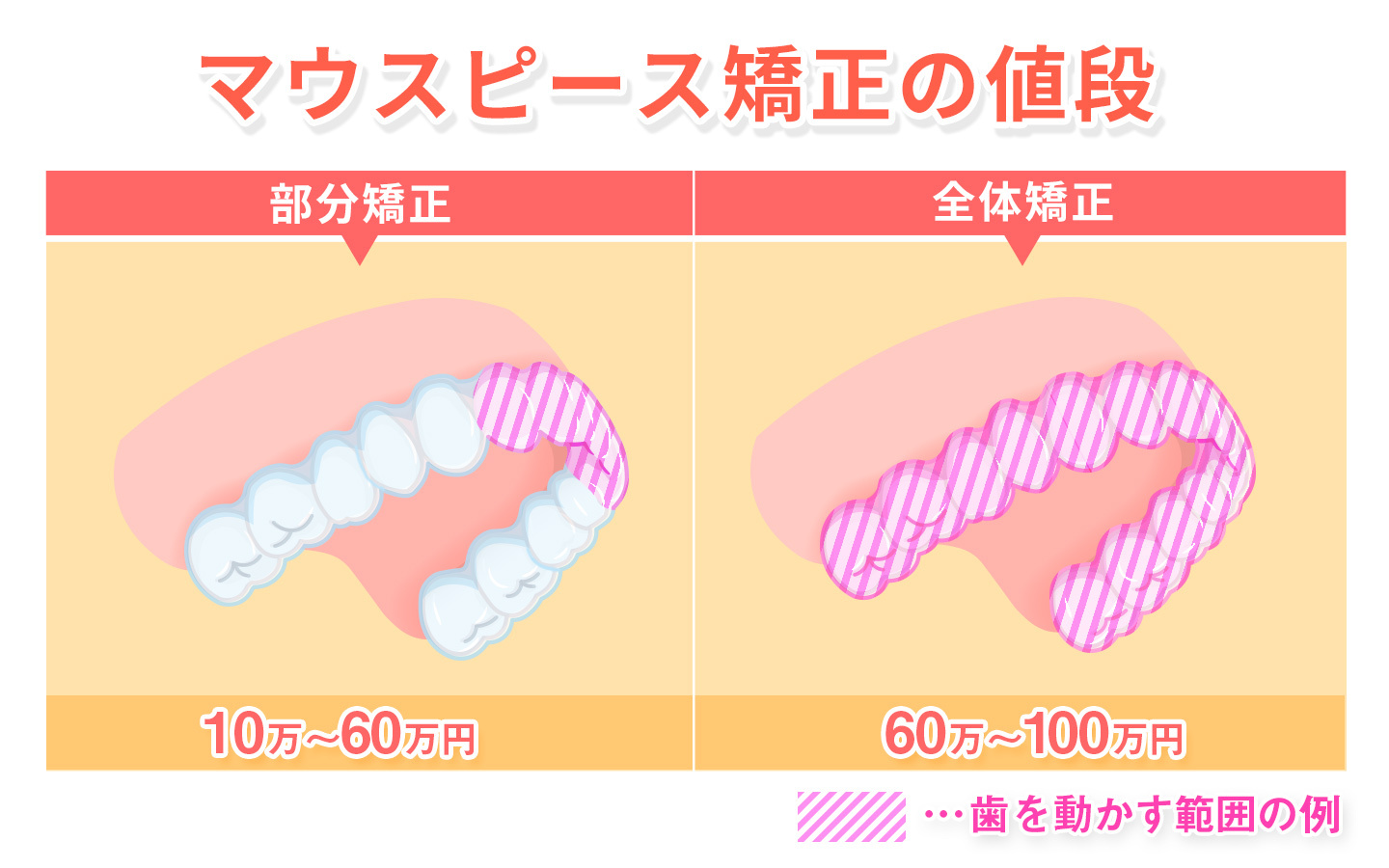 マウスピース矯正
