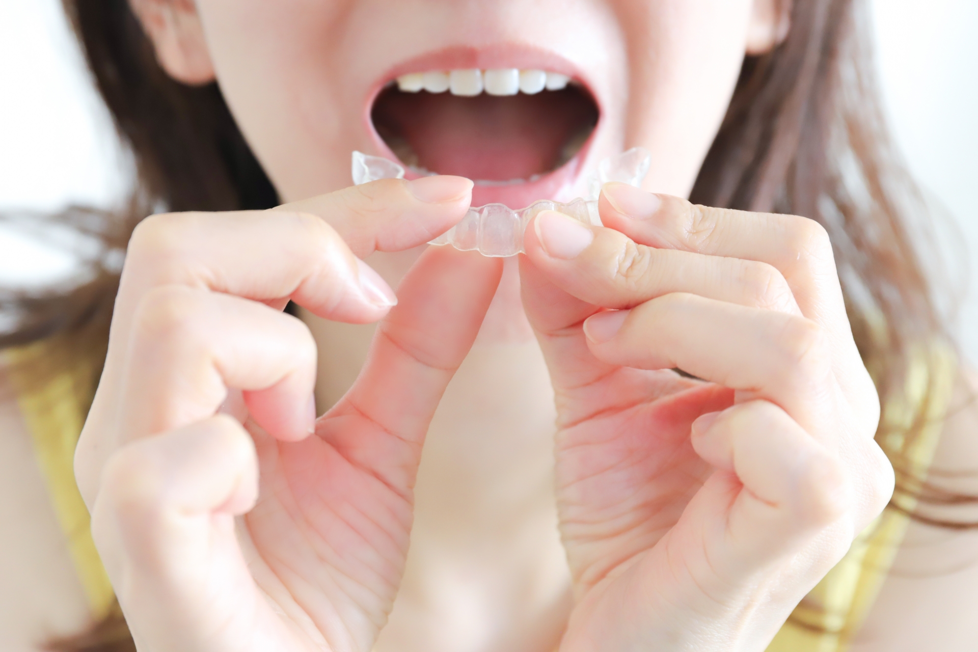 キレイラインとOh my teethの適応範囲は?