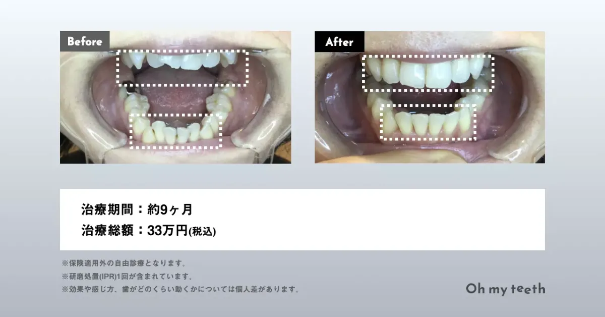 マウスピース矯正 Oh my teethの八重歯(叢生)の症例(部分矯正・非抜歯矯正)