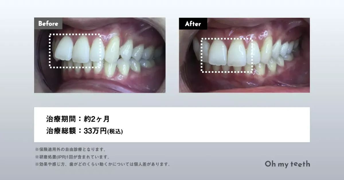 マウスピース矯正 Oh my teethの出