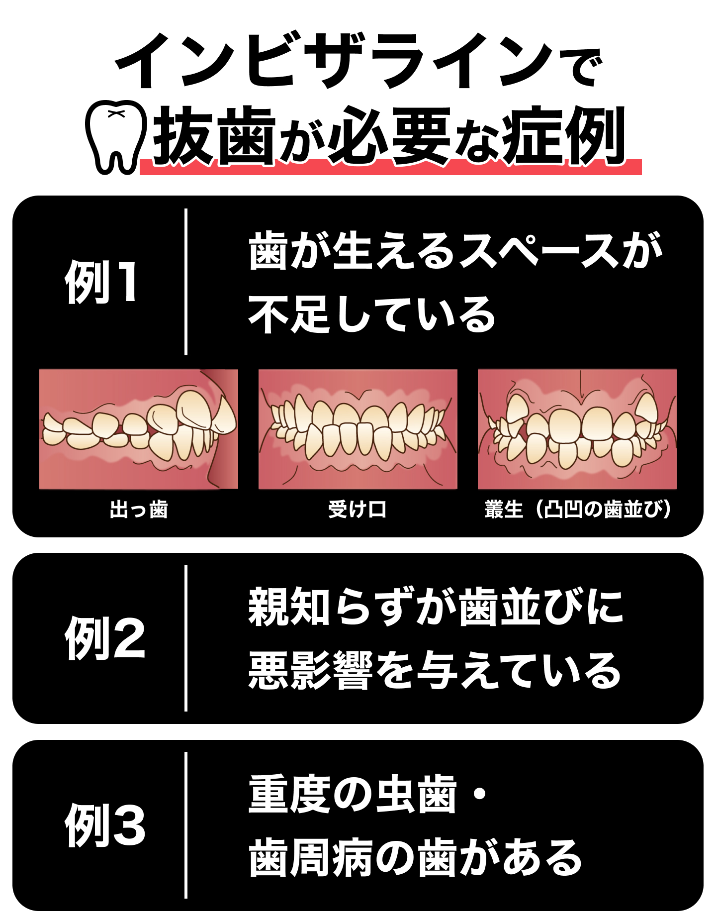 インビザラインで抜歯が必要な症例