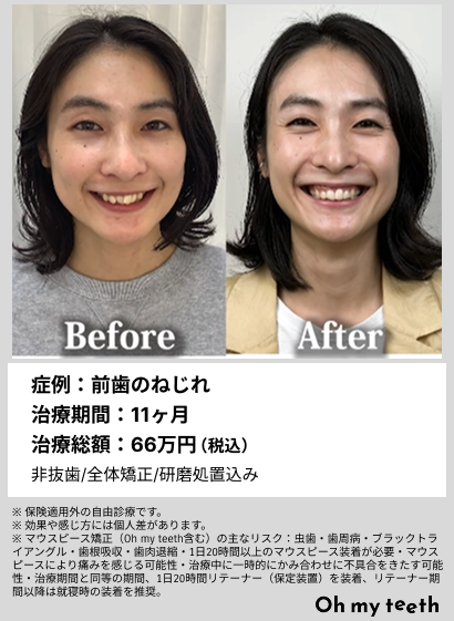 全顔BA・前歯のねじれ