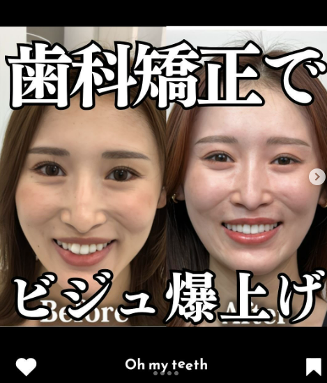 歯科矯正でビジュ爆上げ