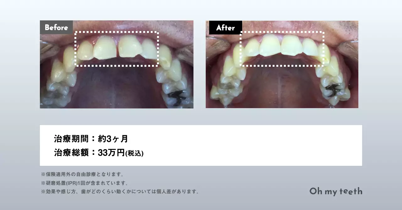 歯科矯正していると就活で不利?就職と歯並びとの関係