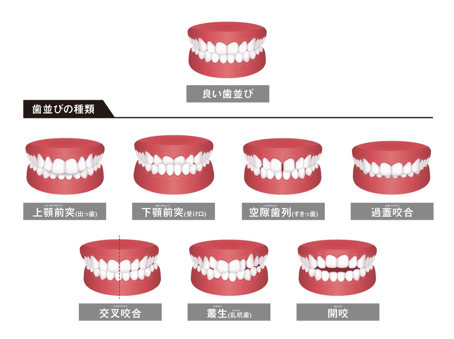 千鳥 ノブさんが歯科矯正を開始!「下の歯が全員寝そべる」とはどんな状態?