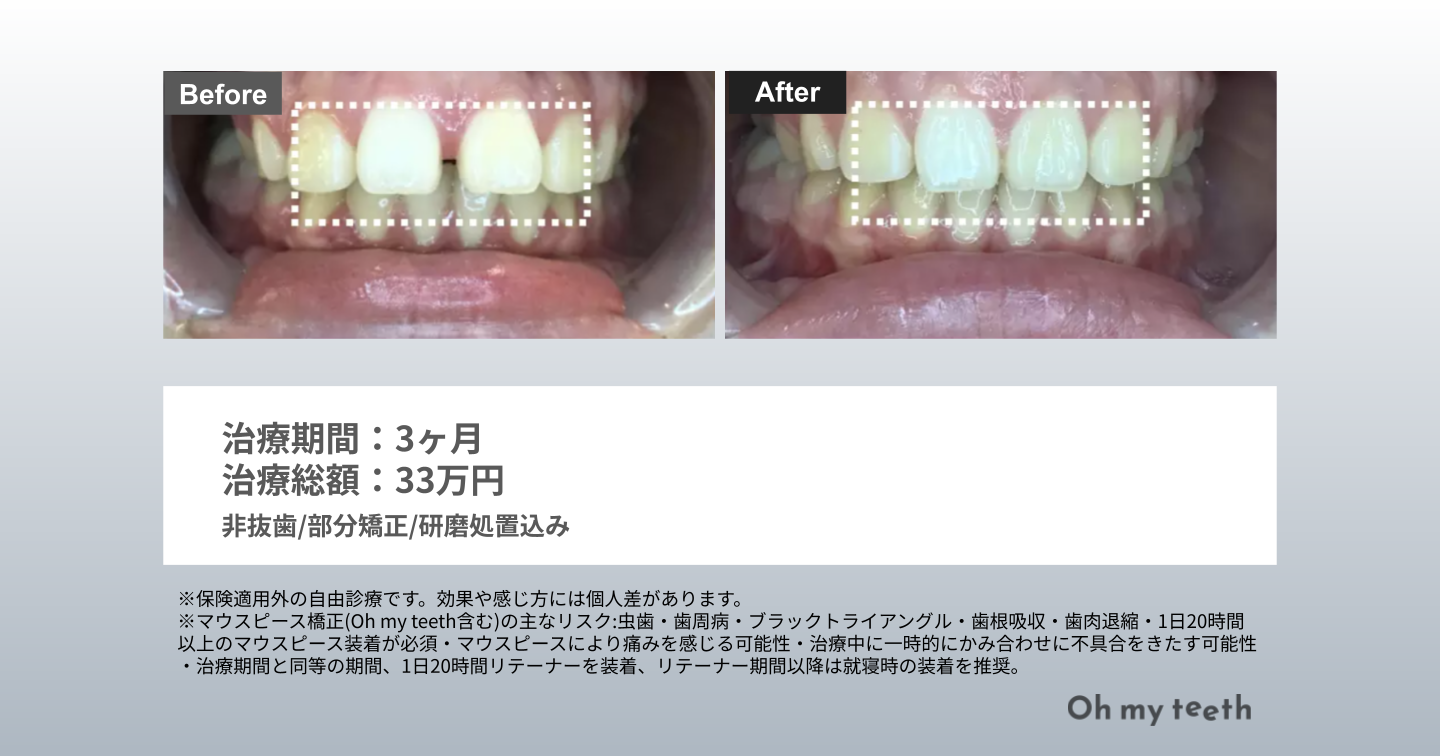 すきっ歯 矯正 前歯だけ症例(すきっぱ3ヶ月)