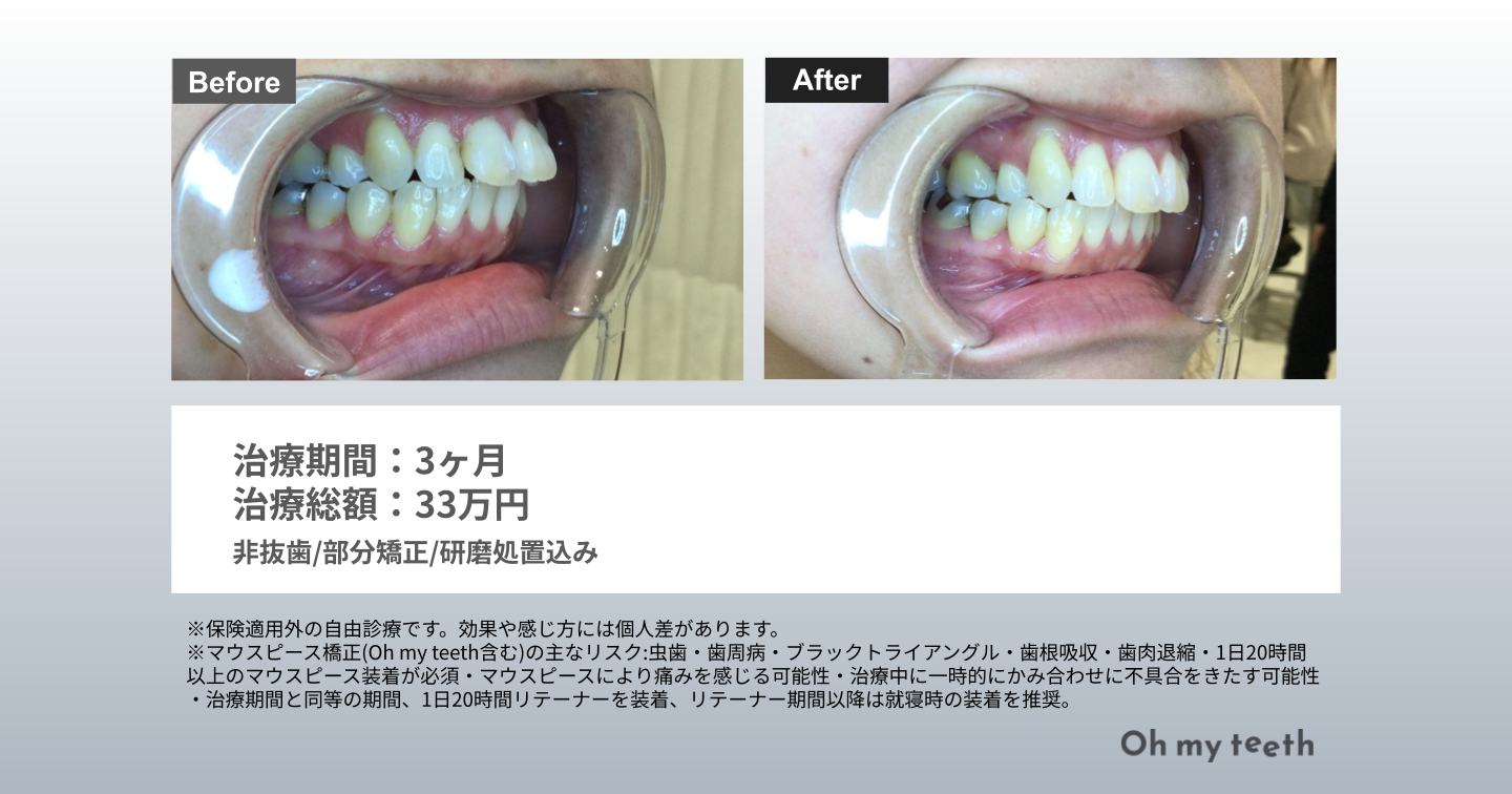 歯列矯正 やってよかった 症例写真データ(出っ歯3ヶ月)