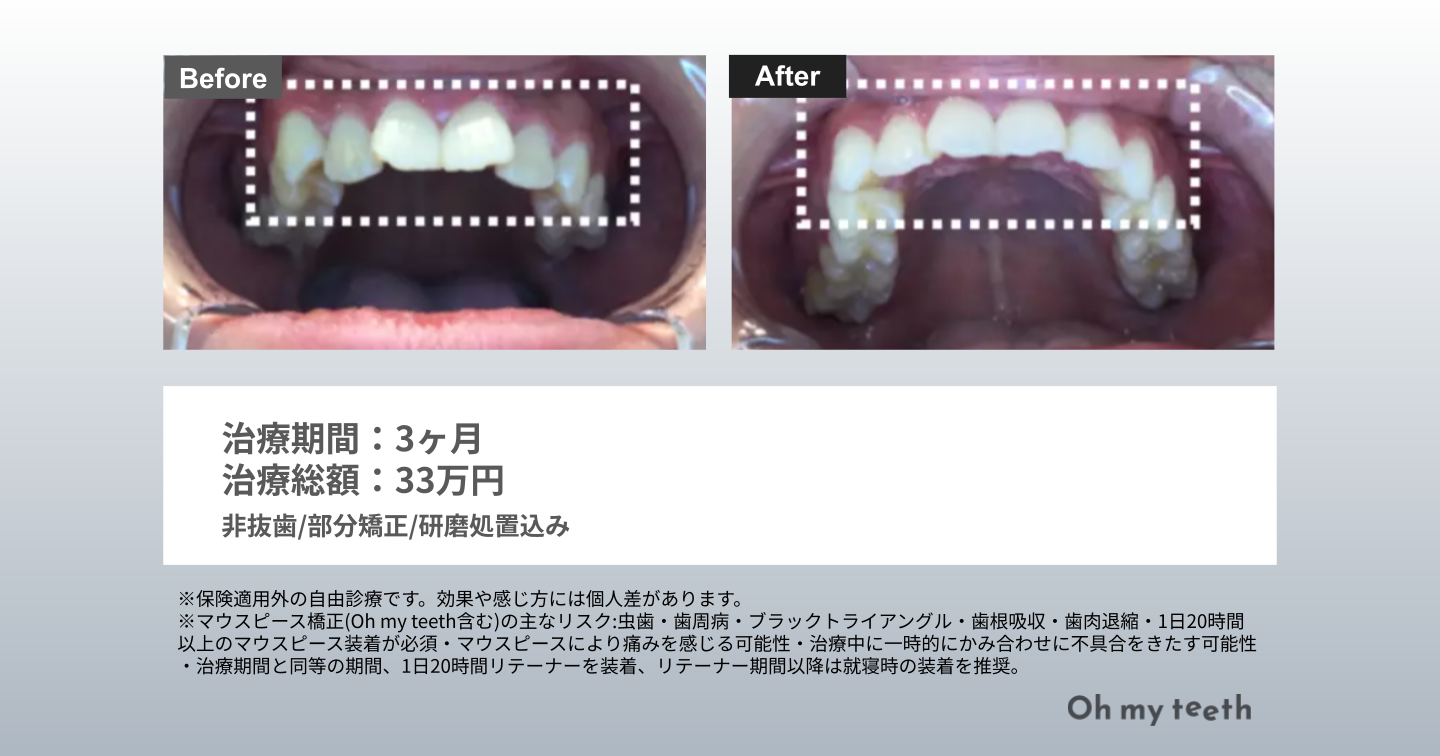 その他(ねじれた前歯)Basic