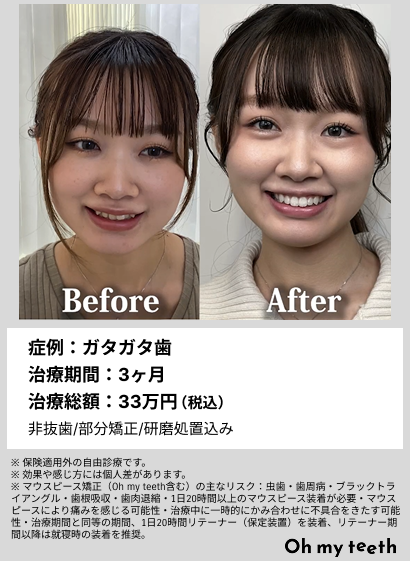 全顔BA・ガタガタ歯