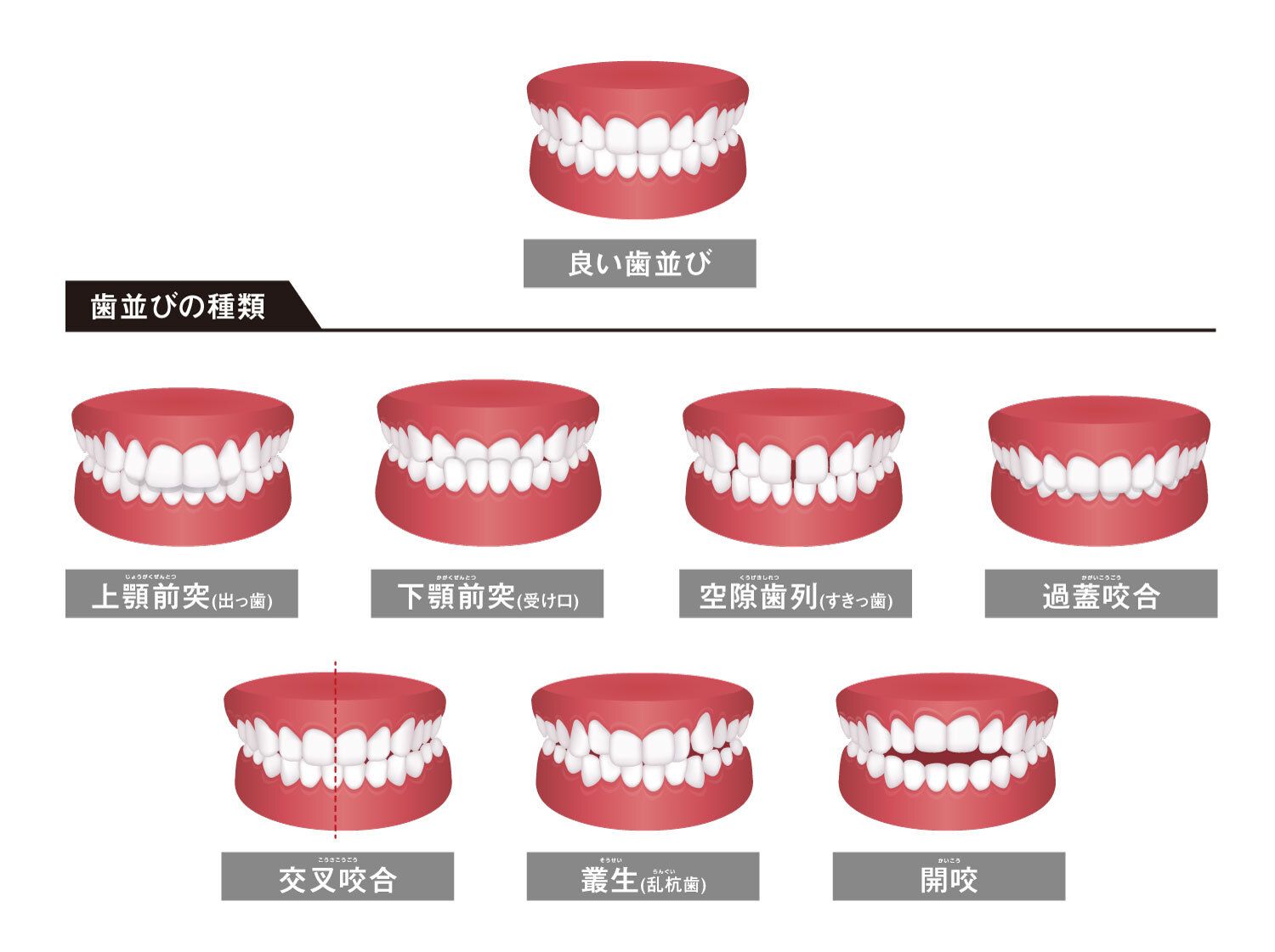 噛み合わせが悪いことで起こる8つの症状!原因や治し方も解説