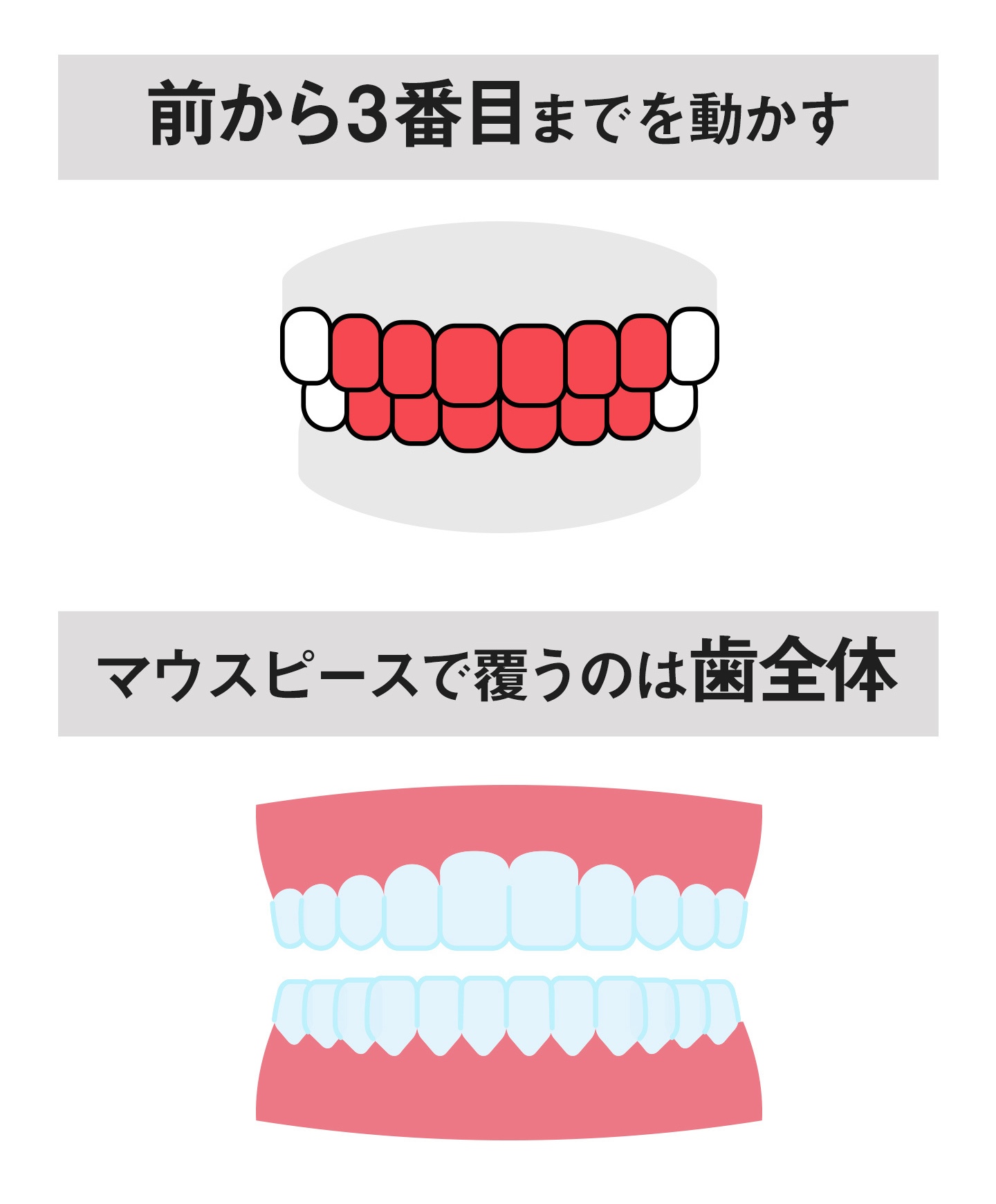 前歯だけのマウスピース矯正とは?