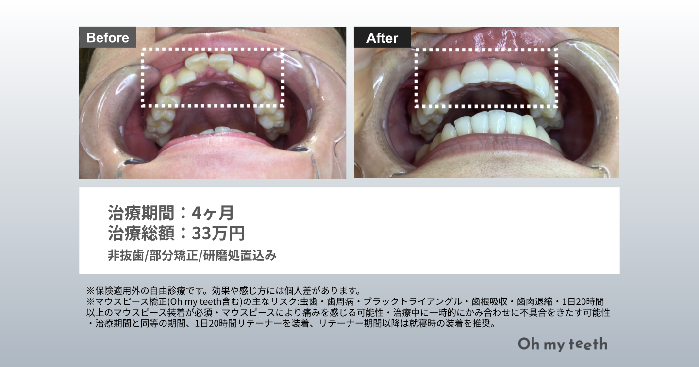 部分矯正 出っ歯 症例画像②