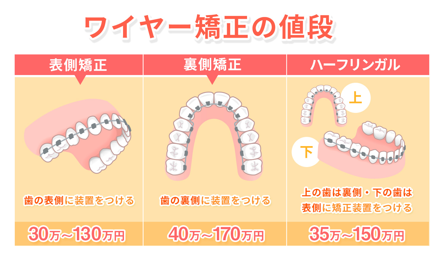 ワイヤー矯正の値段