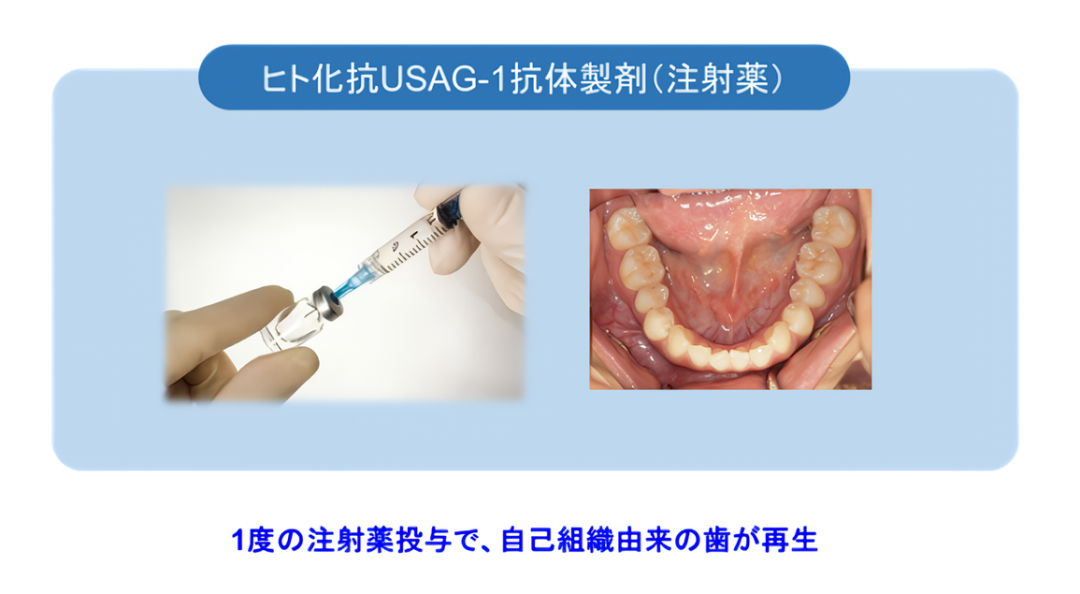 世界初の「歯生え薬」、京大発ベンチャーらが24年9月より治験開始―先天性無歯症の治療への展開を目指す