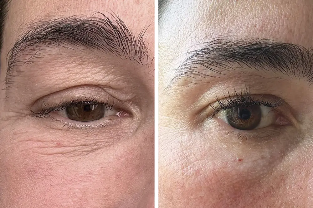Monica Molenaar before and after eye cream use - detail of eye
