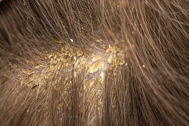 Zoomed head scalp and yellow dandruff between hair.