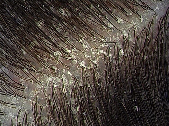 An image of zoomed head scalp showing the dandruff. 
