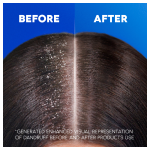 Infographic: Women's hair BEFORE and AFTER using Head&Shoulders shampoo on her hair; *GENERATED ENHACED VISUAL REPRESENTATION OF DANDRUFF BEFORE AND AFTER PRODUCTS USE