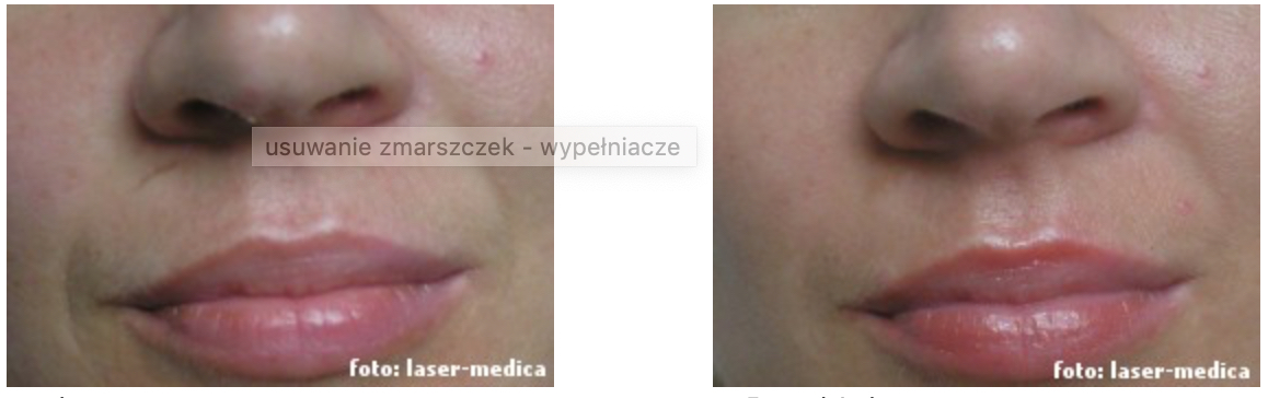 kwas hialuronowy - efekty, korekcja bruzd nosowo-wargowych i blizny pod nosem