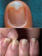 Oddzielenie się płytki paznokciowej (onycholiza)
