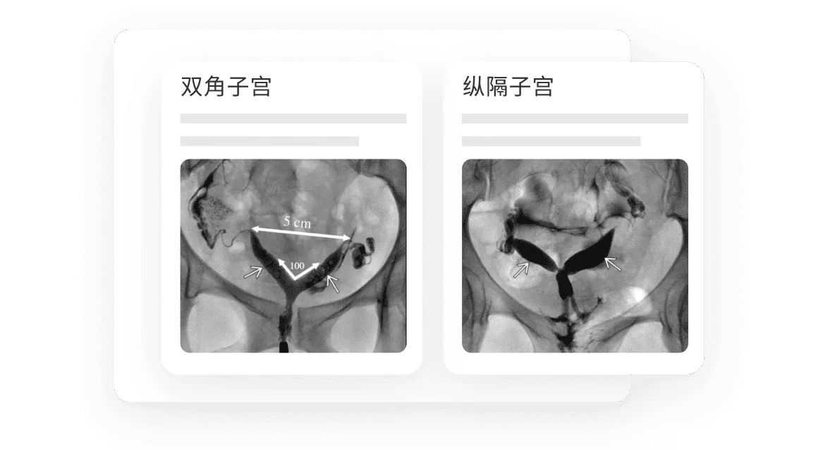 X-ray photographs of a bicornate uterus and a septate uterus