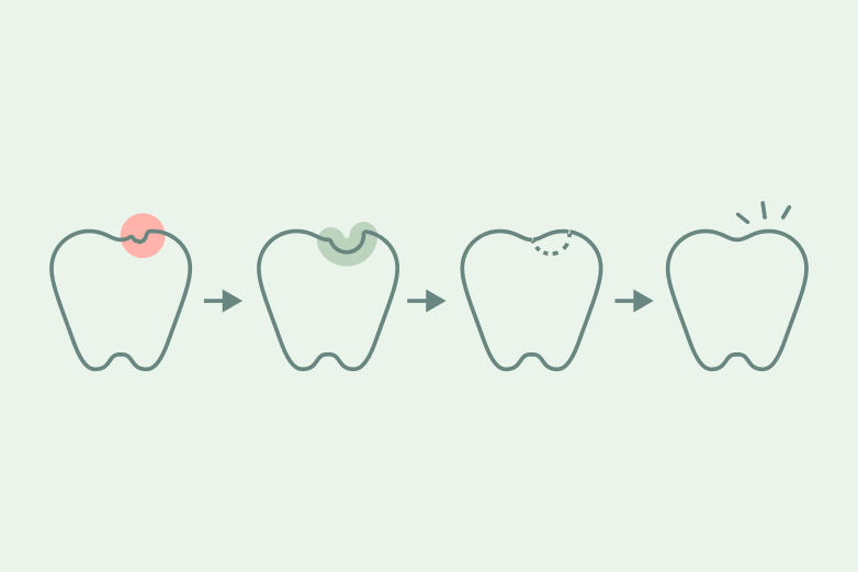 Fillings Infographic