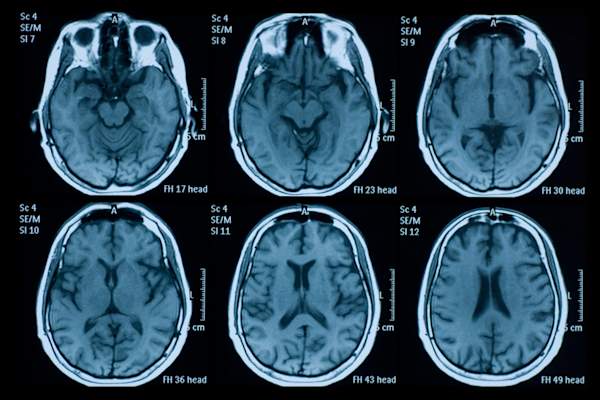 brain MRI