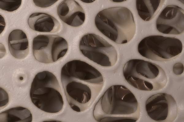 osteoporosis