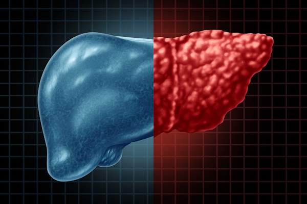 fatty liver disease