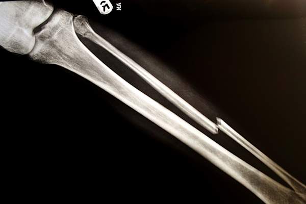 bone fracture