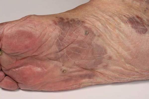 Patch stage Kaposi's sarcoma