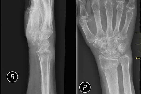 medical x-ray of hand and wrist with osteoporosis