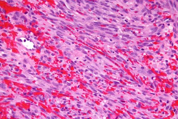 Micrograph of Kaposi sarcoma