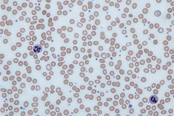 Human blood sample from a case of anemia