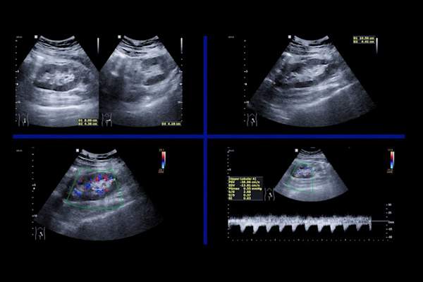 Kidney ultrasound showing renal function