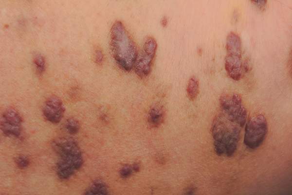 Kaposi sarcoma