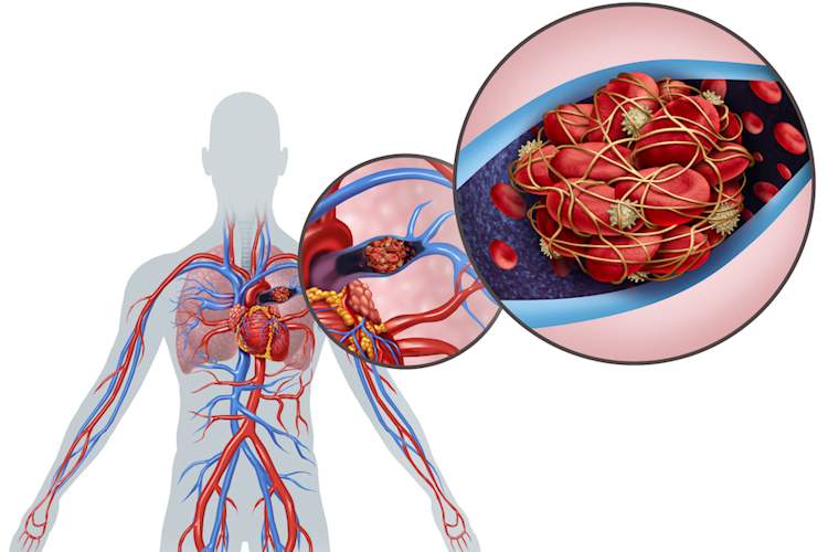 pulmonary embolism