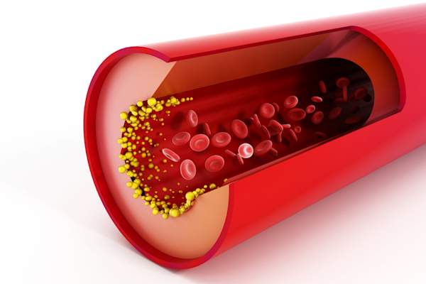 lipid particles