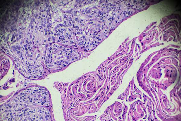 cervical cancer