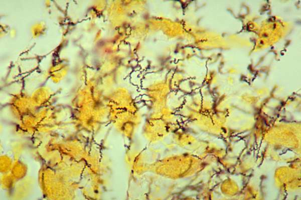 Histopathology of Treponema pallidum spirochetes using a modified Steiner silver stain.