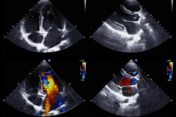 Echocardiography