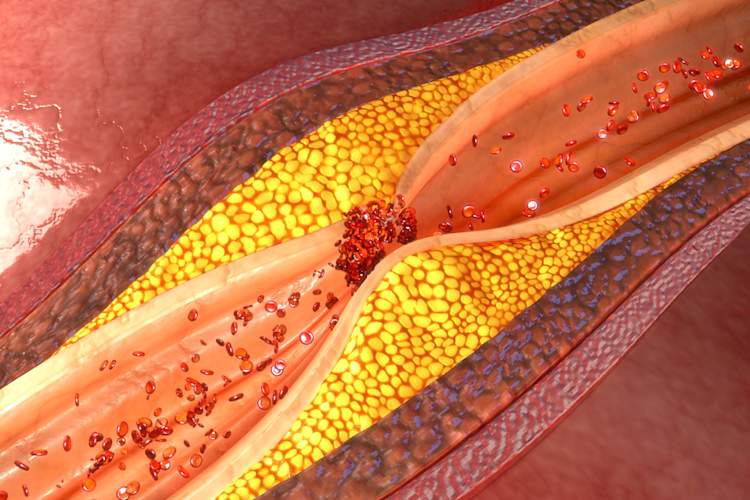 coronary atherosclerosis