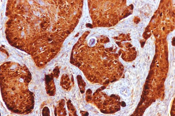 Anal squamous cell carcinoma associated with HPV infection