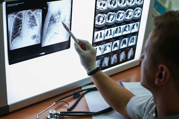 radiographs of COPD