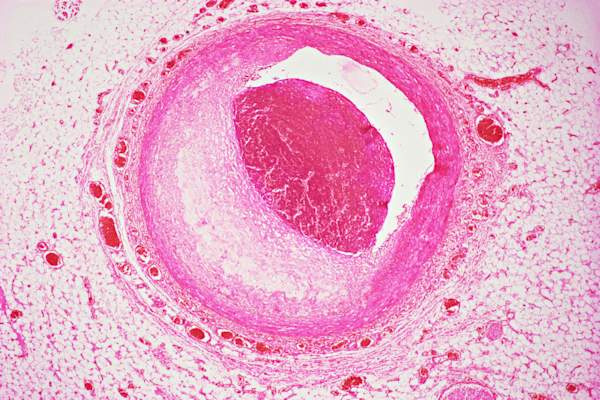 Atherosclerosis in coronary artery
