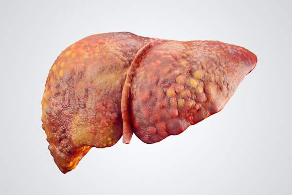 Liver cirrhosis